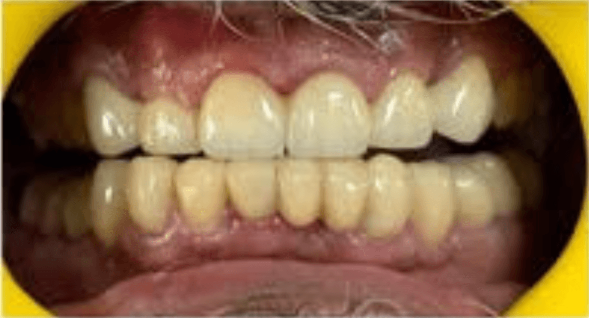 After dental treatment at Dental Lifeline Panchkula