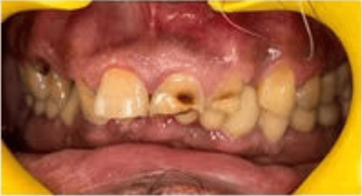 Before dental treatment at Dental Lifeline Panchkula