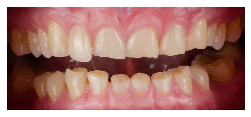 Dental Night-guards : Your Silent Protector While You Sleep