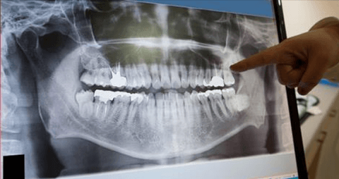 Dental X-Rays Are Safe