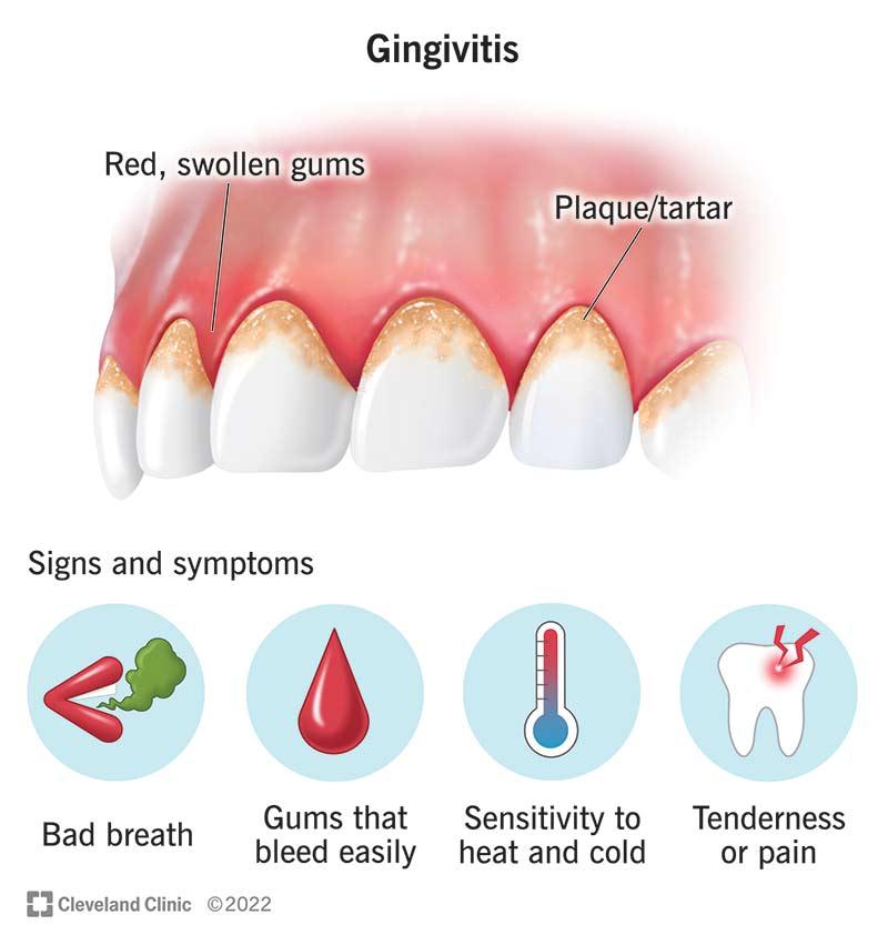 Gum Disease